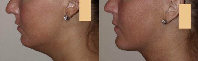structural-fat-grafting-chin